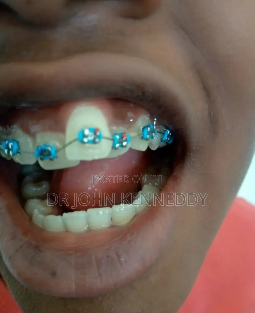 Braces ( Orthodontics)