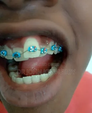 Braces ( Orthodontics)