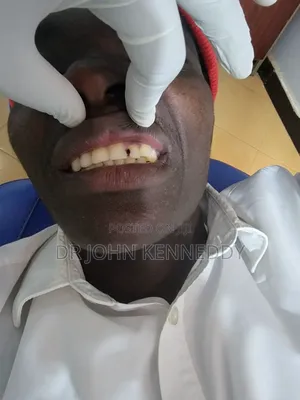 Tooth Restoration
