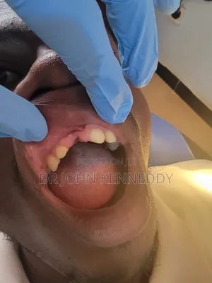 Denture Tooth Replacement