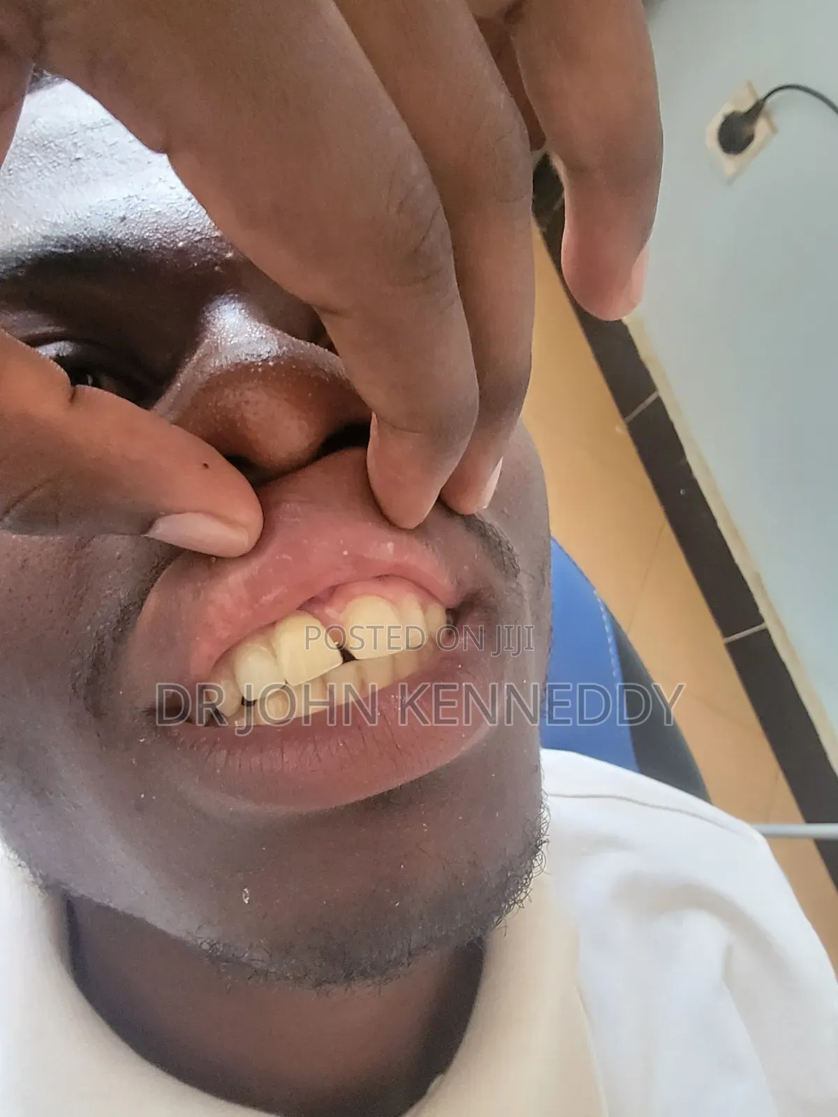 Denture Tooth Replacement