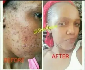 Stemcelltherapy
