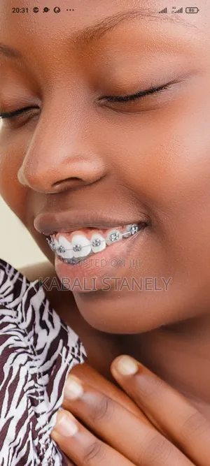 Dental Braces