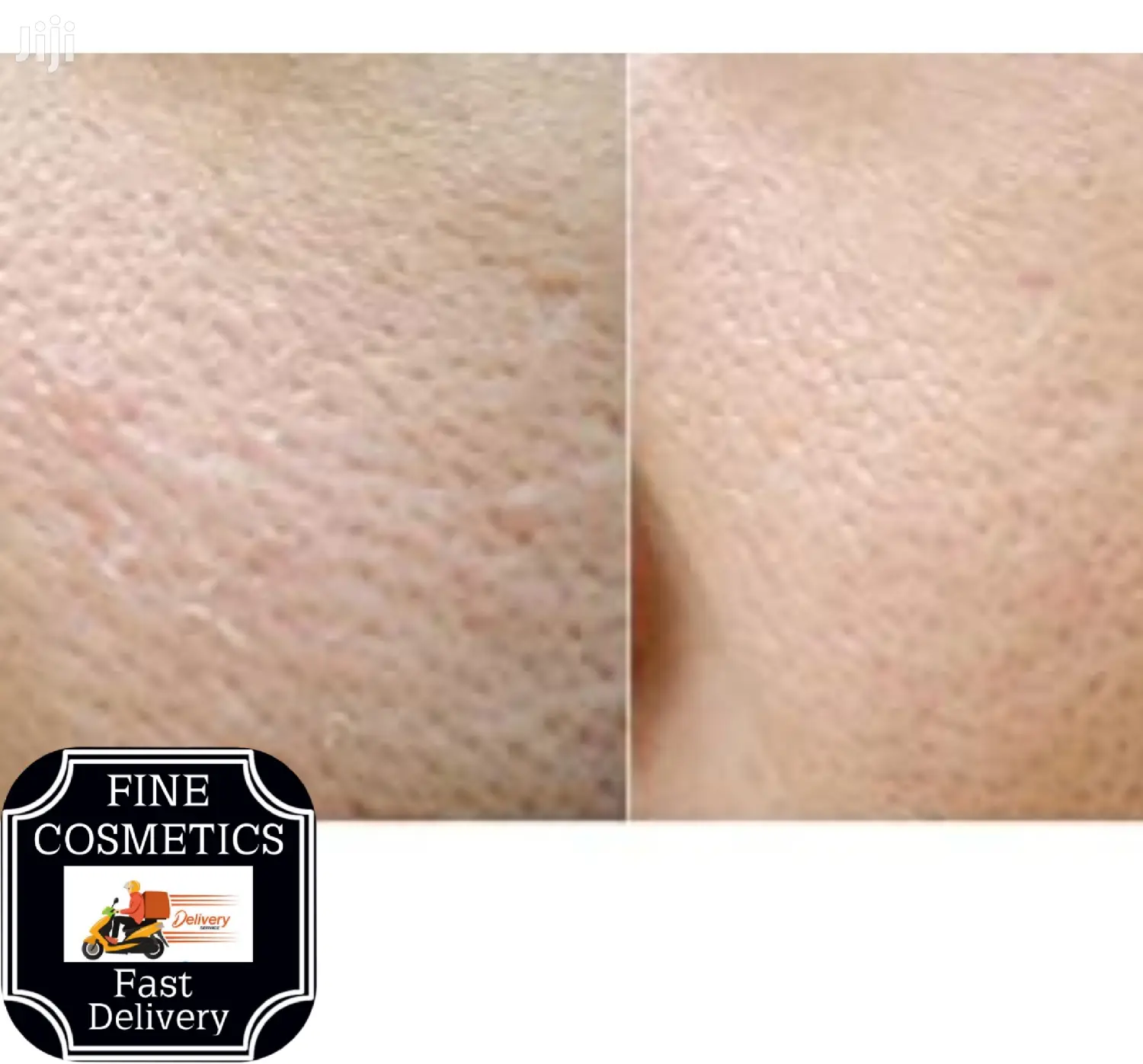 Pimples And Blackheads Remover Needle Without Leaving Scars